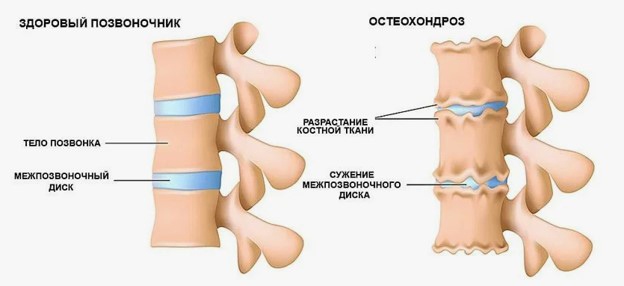 Что такое остеохондроз